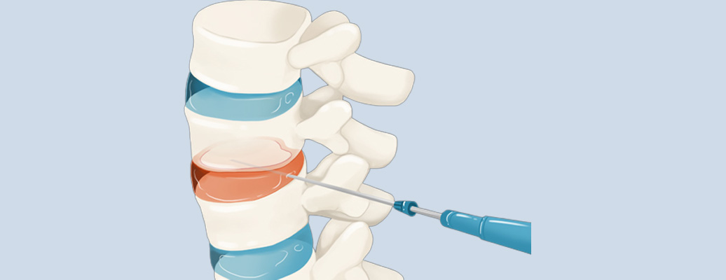 신경성형술 이미지