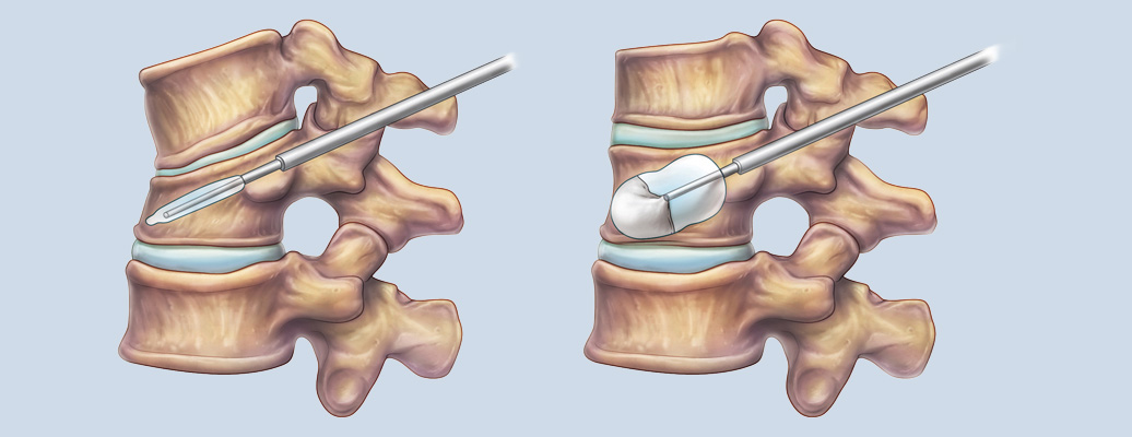 척추체성형술 이미지