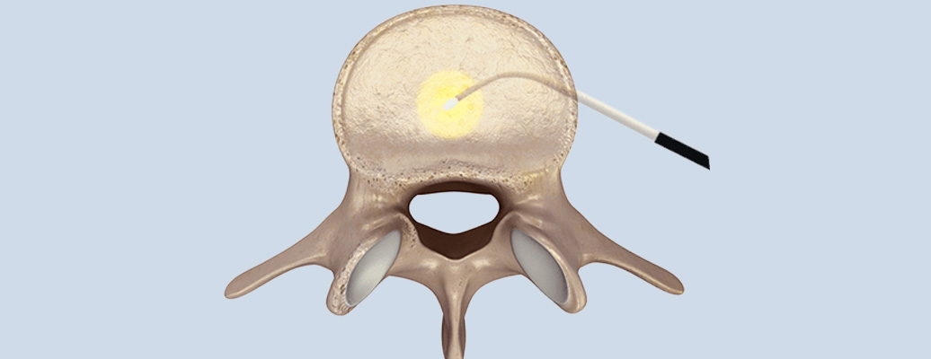 고주파수핵감압술 이미지