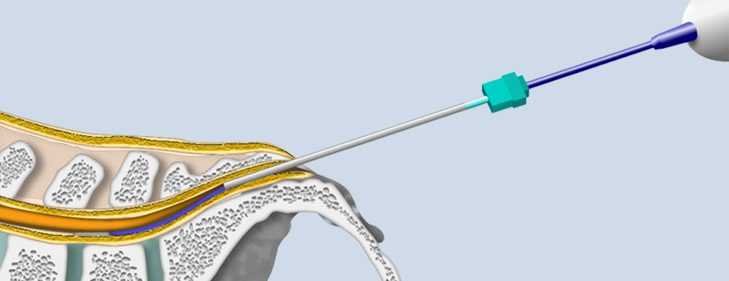 풍선확장술 이미지