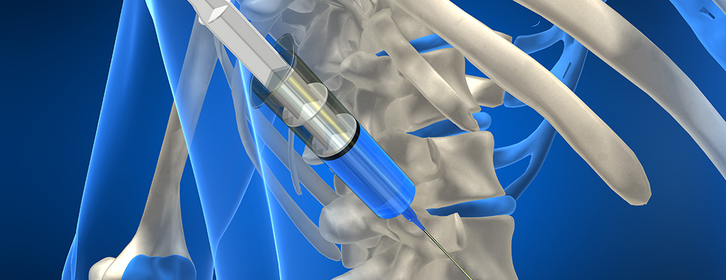 c-arm guide 주사치료